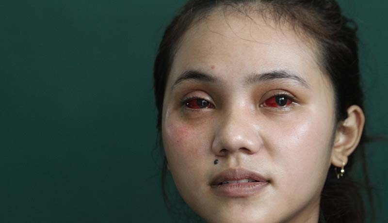 Foto 2 Gadis Cantik Aremania Menderita Mata Merah akibat Terkena Gas Air Mata - Bagian 2
