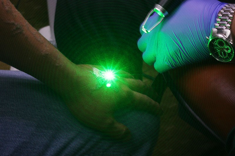 Hapus Tato Gratis dengan Laser - Bagian 1