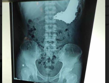 Ngeri! Tim Dokter Temukan 70 Paku dalam Perut Pria di Indramayu
