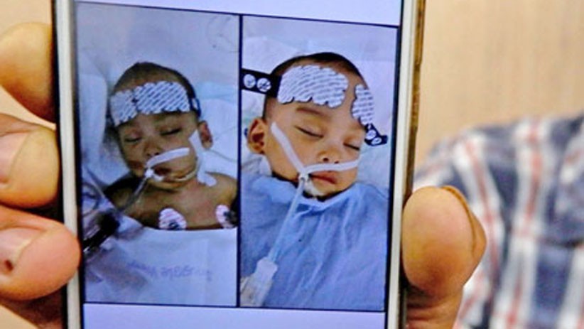 Bayi Kembar Siam di Sumatera Utara Berhasil Dipisahkan, Begini Kondisinya - Bagian 1